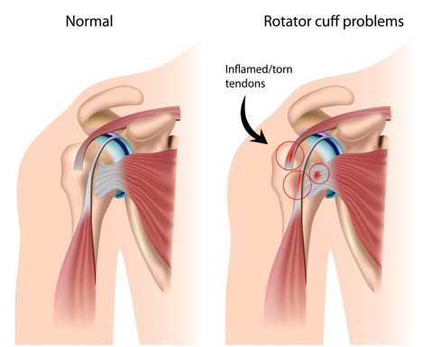 Swimmer Shoulder Muscles